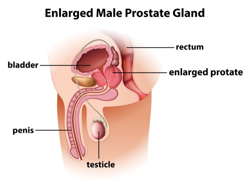 enlarged prostate.jpg